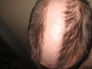 Kainuulaisten miesten hiustenlähtö ihmetyttää tutkijoita. Useat parturit työttöminä ja sosiaalihuollon varassa.